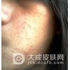 得了青春痘应该怎么洗脸