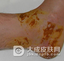 丹毒为什么会复发呢