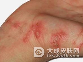 专家解析疥疮反复发作的原因是什么