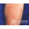 面部脂溢性皮炎症状表现是什么