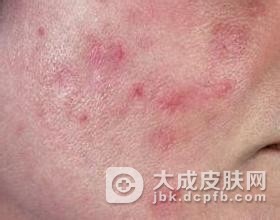 中年人皮肤上也会长青春痘吗