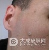 青春痘的类型有哪些?