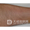 治疗小腿丹毒要注意什么