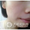 青春痘可以根据症状分成三个等级