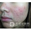 怎样杜绝青春痘复发?