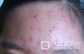 冬季脸上青春痘吃什么好?