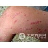 银屑病患者该怎么护理