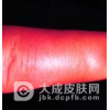类丹毒的皮肤表现是什么