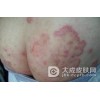 银屑病患者治疗后该如何护理