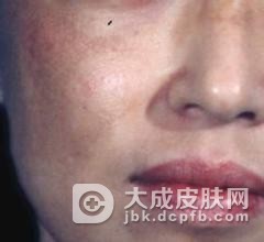 黄褐斑患者需要有哪些要注意