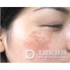 黄褐斑患者要怎样养护自己的皮肤