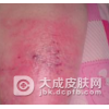 怎样处理类丹毒比较好