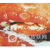口腔粘膜病的生活调理