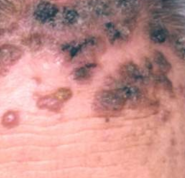 皮肤结核病的发生原因有哪些