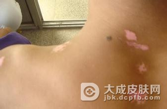 预防白癜风的方法有哪些