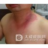 夏季小心隐翅虫皮炎