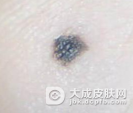 恶性黑色素瘤的类型介绍