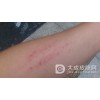 皮肤瘙痒的发病原因有哪些