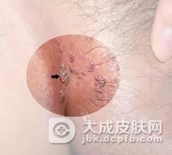 尖锐湿疣对男性都有那些危害