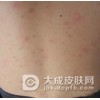 寻常型银屑病应怎样护理