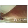 脂肪瘤是什么原因引发的