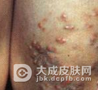 患了黄瘤病要怎么做