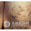 患了黄瘤病要怎么做