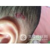 如何发现早期血管瘤