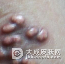 黄瘤病的发病特点有哪些