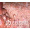 黄瘤病的处理措施有哪些