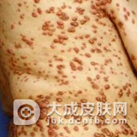 黄瘤病如何护理呢
