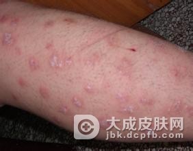 该怎样预防玫瑰糠疹的病发呢