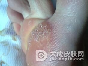 跖疣所带来的危害有哪些