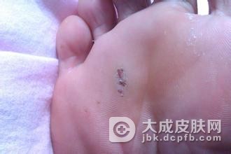 跖疣如何预防效果好