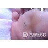 跖疣如何预防效果好
