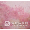 赤游丹是什么病毒引起的