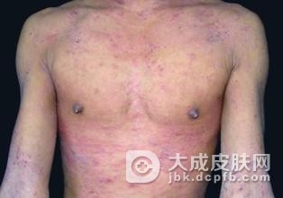 过敏性皮炎多因季节性皮肤干燥病引起