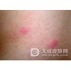 过敏性皮炎病人吃哪些食物会加剧病情