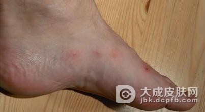 内外结合治疗孩子过敏性皮炎