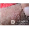 有淋病需要特别注意什么