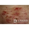 淋病反复发作的8大原因