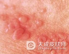 哪些因素容易诱发淋病发生