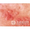 哪些因素容易诱发淋病发生