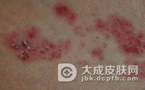 带状疱疹能吃哪些食材
