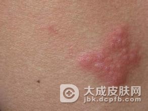 冬季怎么预防带状疱疹较好
