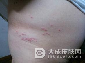 初期带状疱疹有什么症状