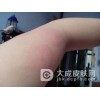 如何判断胆碱性荨麻疹