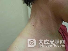 导致过敏性皮炎的原因有哪些