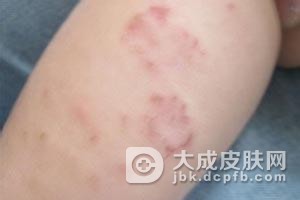 手部过敏性皮炎的护理方法有什么