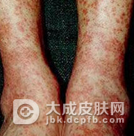 结节性血管炎该如何治疗呢